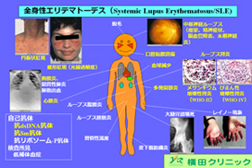 全身性エリテマトーデス